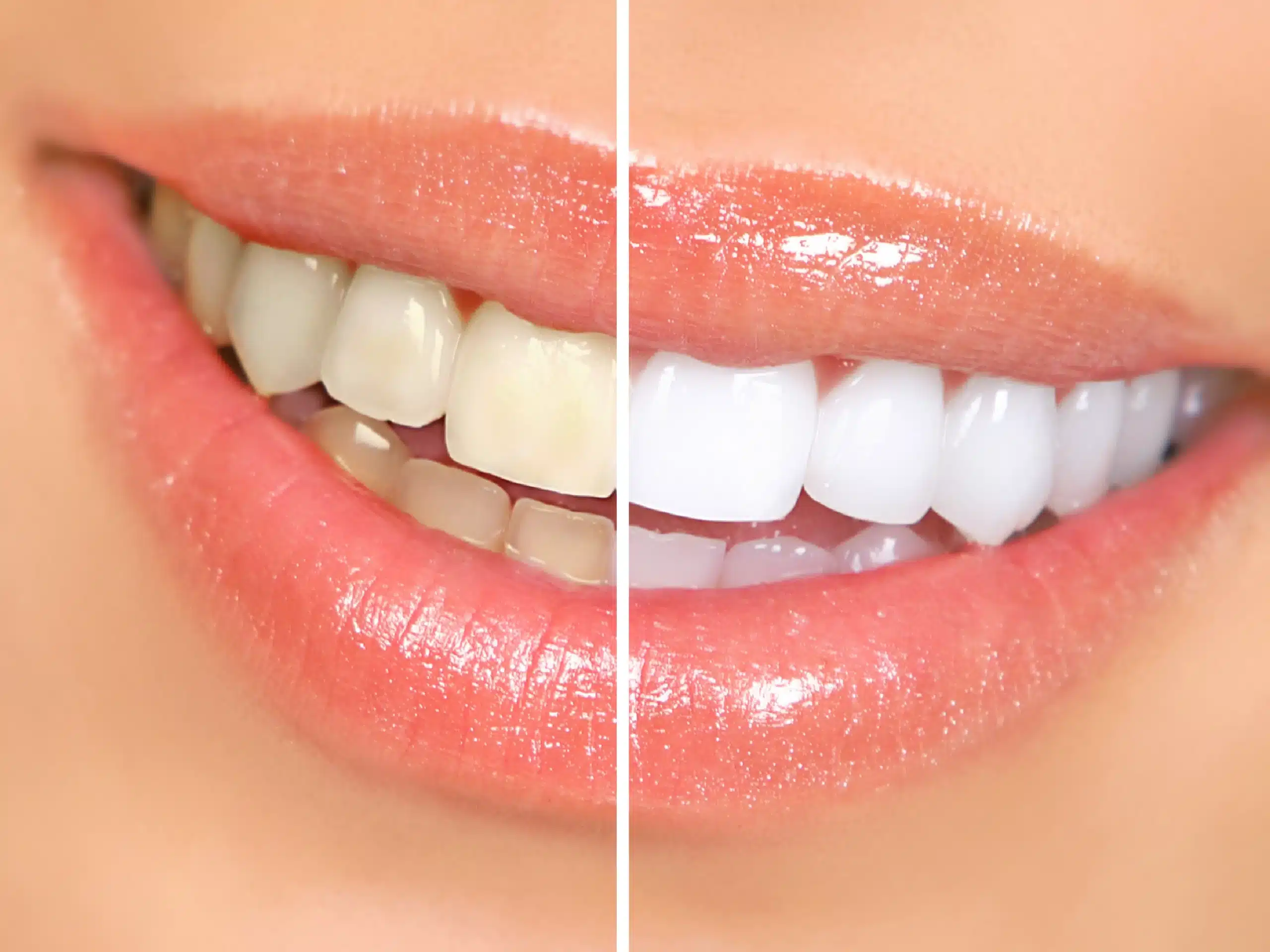 Teeth-Whitening-08